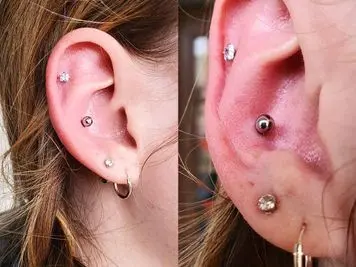 conch piercing infection
