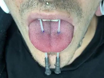 double tongue piercing procedure