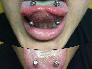 double tongue vs multiple tongue