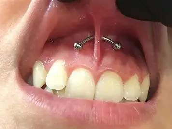 getting a smiley piercing