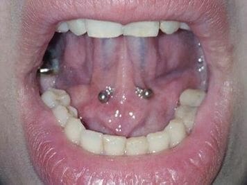 image of tongue webbing