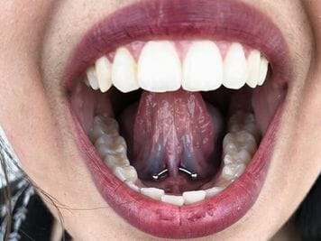 image of under tongue piercing