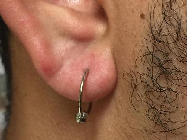 infected ear lobe piercing