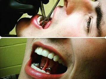 procedure of under tongue piercing
