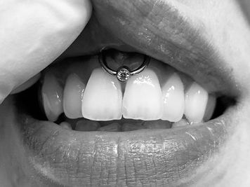 smiley piercing and braces
