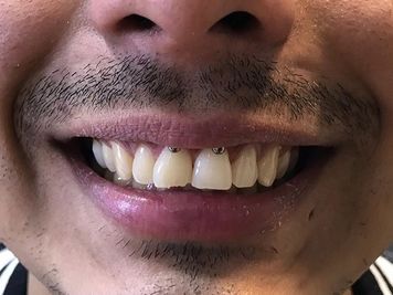 smiley piercing gap teeth