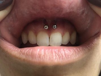 smiley piercing review