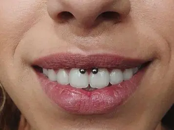 swollen smiley piercing