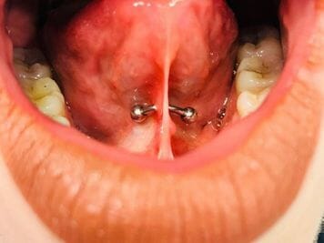 tongue frenulum piercing rejection