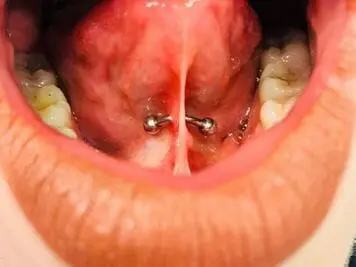 tongue frenulum piercing rejection
