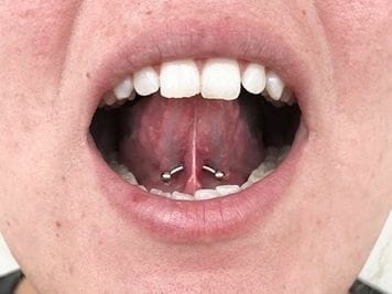 tongue frenulum piercing risks