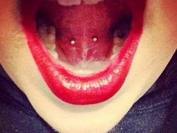 tongue frenulum price