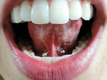 tongue web piercing healing