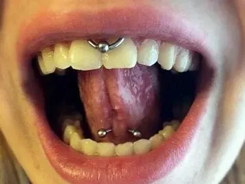 tongue web piercing infection