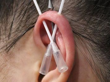 trident piercing procedure